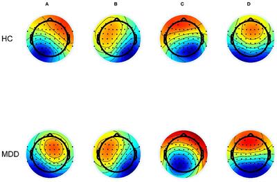 Abnormalities in Electroencephalographic Microstates Among Adolescents With First Episode Major Depressive Disorder